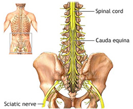 clinical negligence and cauda equina syndrome
